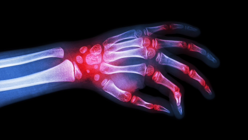 Is Guaiacum Sanctum Effective Against Arthritis?