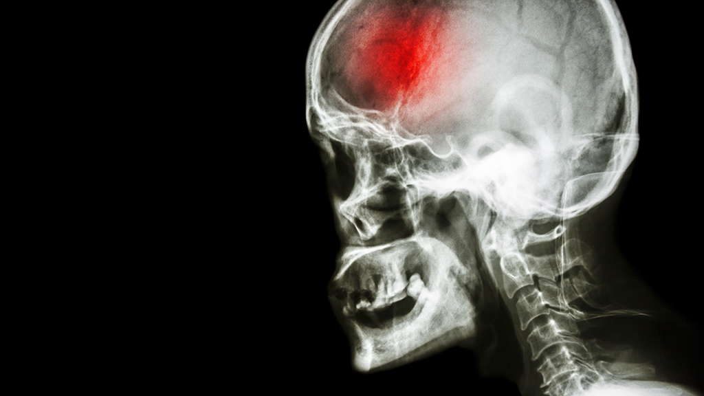 A Tradesman’s Journey Back from a Cerebral Incident